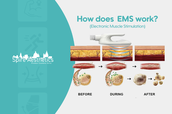 EMS treatment for post pregnancy weight loss treatment Lewisham