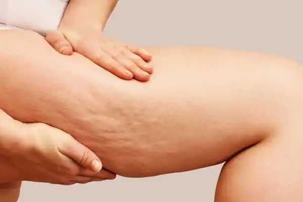 Image of woman showing leg with cellulite Lewisham