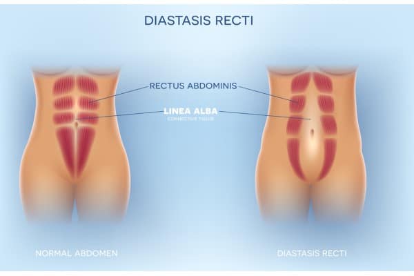 What Non-Surgical Options Are Available for Diastasis Recti Lewisham?