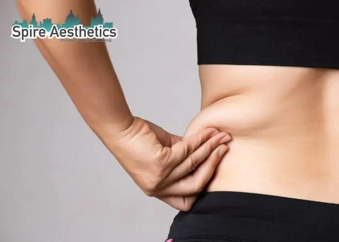 Image of woman pinching fat on their hips Lewisham. Fat Freezing treatment