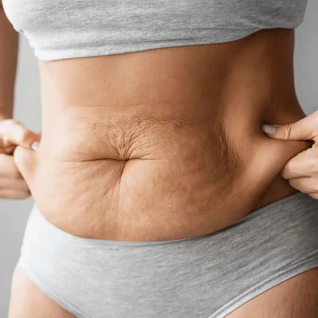 Is It Normal to Have Loose Skin After Pregnancy Lewisham?