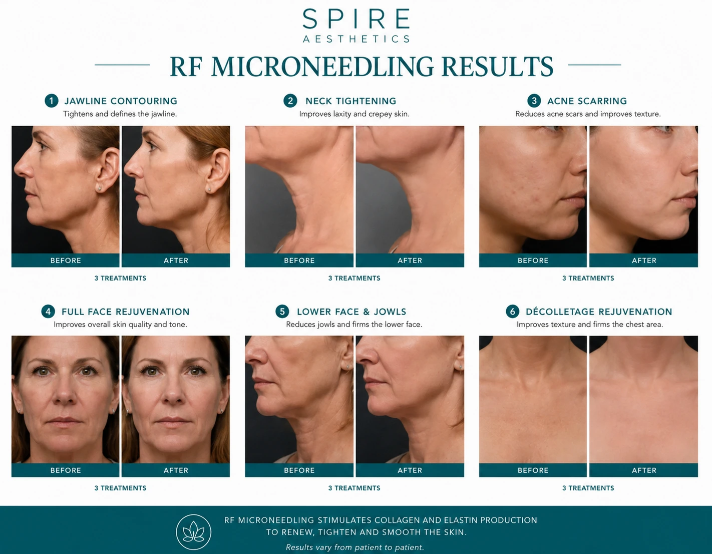 RF Microneedling Skin tightening Lewisham results