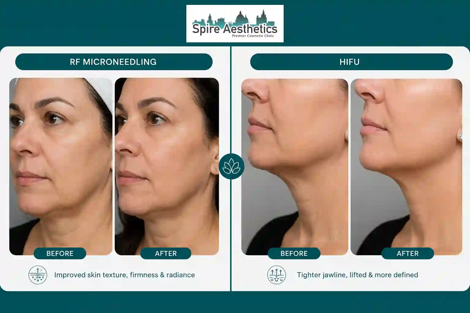 Can RF Microneedling and HIFU Be Combined Lewisham?