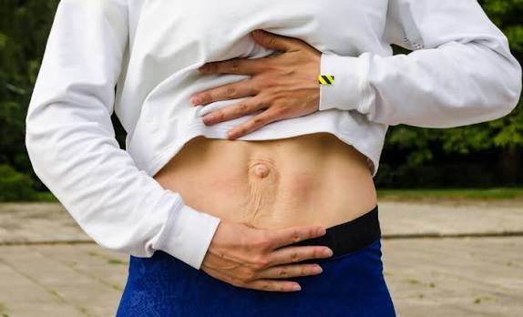 When Could Diastasis Recti Be the Missing Piece of the Puzzle Lewisham?