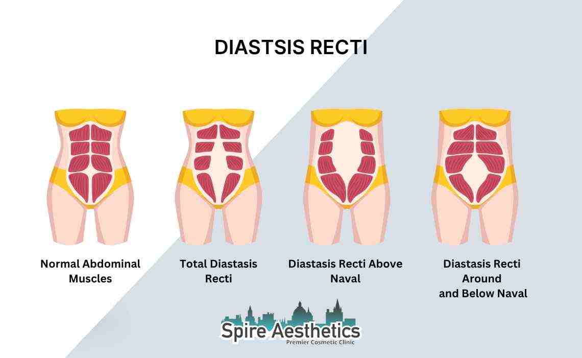 Is Non-Surgical Diastasis Recti Treatment Right for You? Common Concerns Answered Lewisham